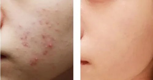 去痘印手术多少钱