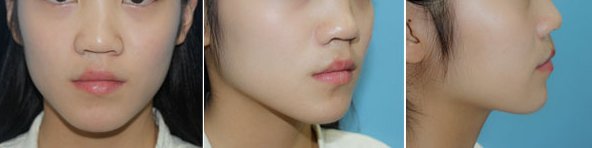 鼻头缩小手术效果对比图