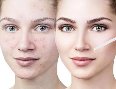 祛痘用什么产品好