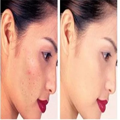 瘦脸针打几次能定型