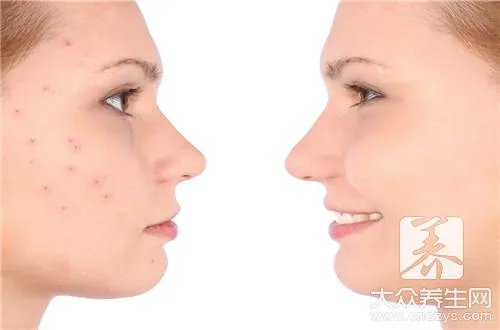 去豆印的有效方法小妙法