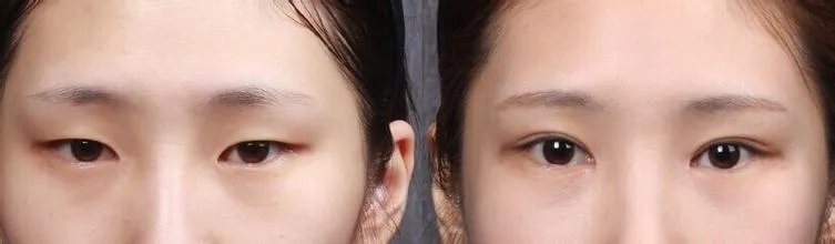 开眼角手术安全么？