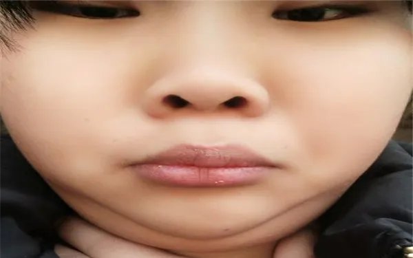 双下巴怎么去除