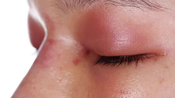 注射透明质酸有什么副作用?