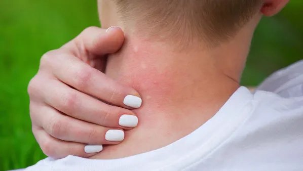 春天皮肤过敏怎么办