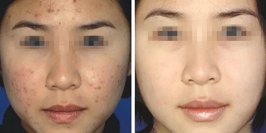 激光美容要多少钱