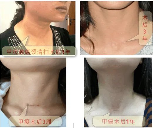 甲状腺癌慎用射频消融治疗