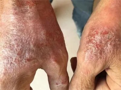慢性接触性皮炎手背皮肤增厚图片