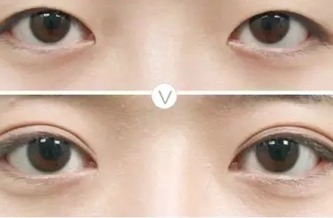 双眼皮的埋线价格