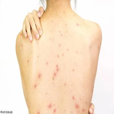 如何有效治疗体癣 有效治疗体癣的四个方法揭秘