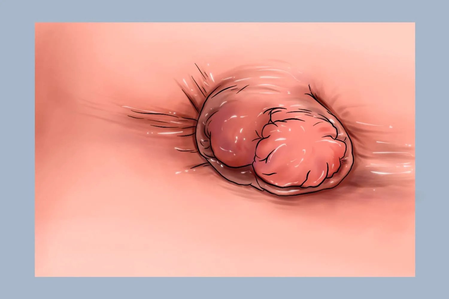 正常肛门与痔疮肛门图片