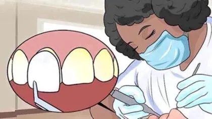 如何修复牙釉质