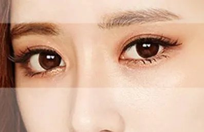 北京割双眼皮价格