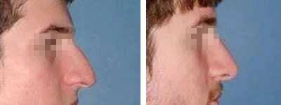 鹰钩鼻整形多少钱？