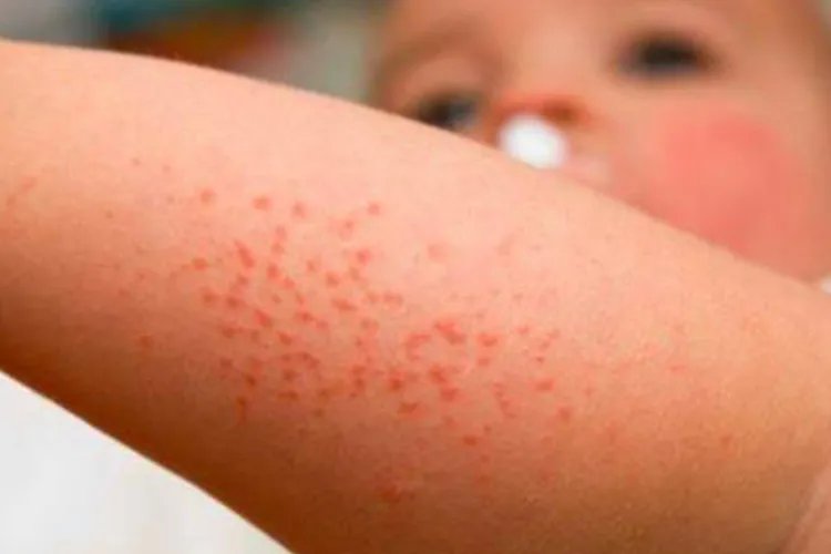 玫瑰疹的症状图片