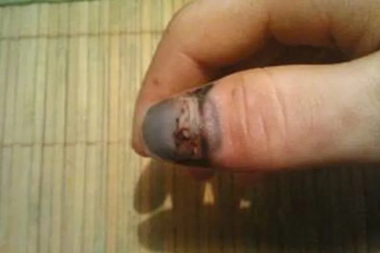 甲下黑色素瘤和瘀血照片对比