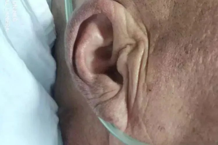 耳褶心征的鉴别图