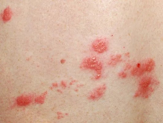 干扰素治疗疱疹的功效