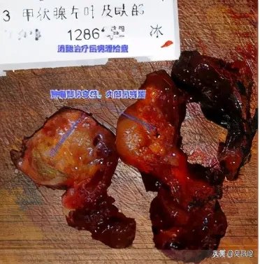 甲状腺癌慎用射频消融治疗