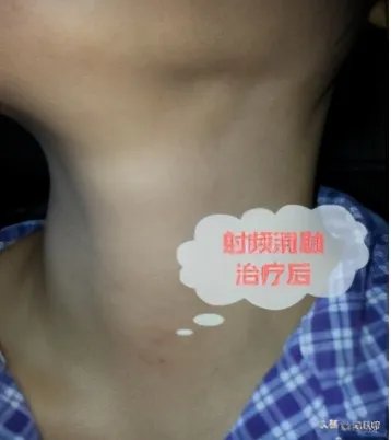 甲状腺癌慎用射频消融治疗