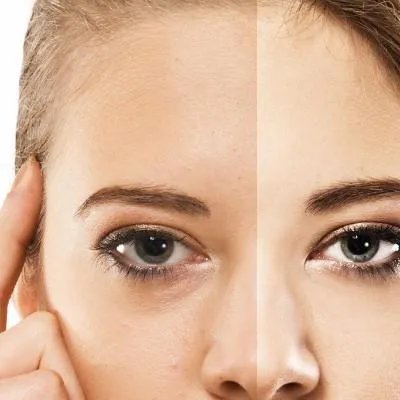 玻尿酸注射的费用