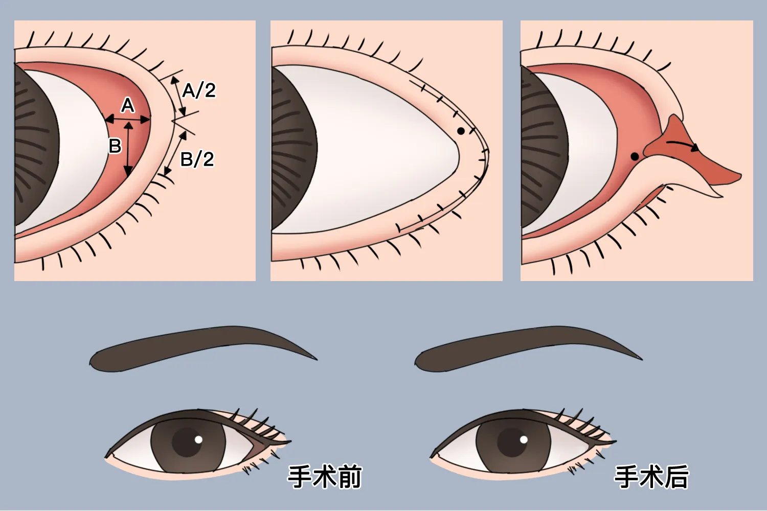 开眼角手术过程图