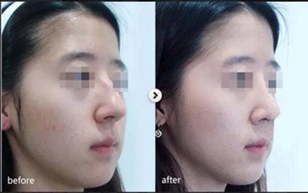 隆鼻整形北京哪家医院好?