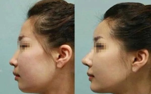 隆鼻整形北京哪家医院好?