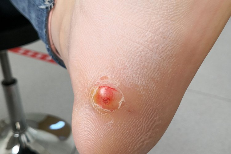 脚底皮肤病症状及图片