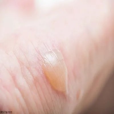 被烫伤起泡应该怎么办 被烫伤起泡了要注意什么