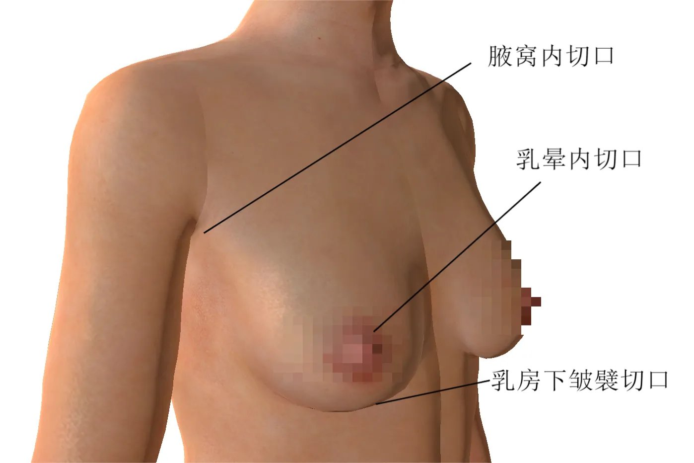 隆胸切口在什么位置好