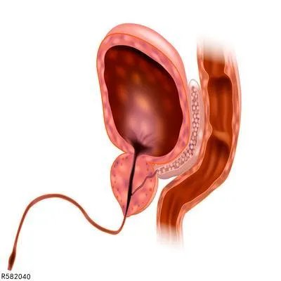 慢性前列腺炎如何食疗  这四个食疗方有助于前列腺康复