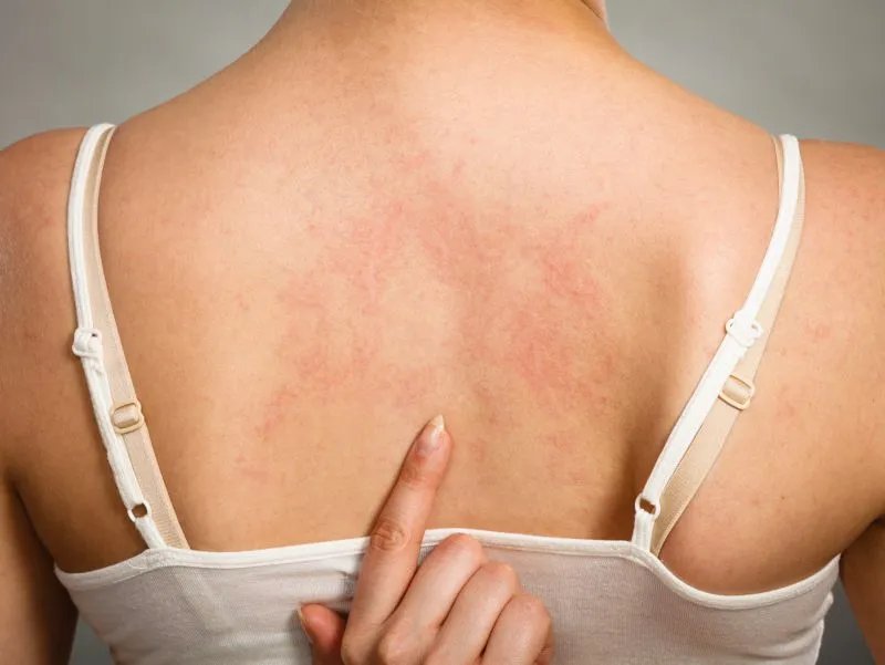 过敏性皮肤症状